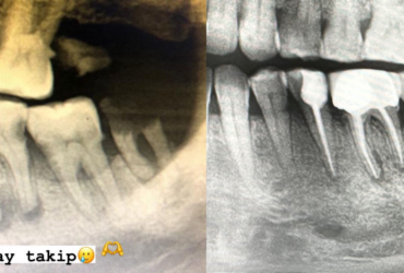 Endodonti (Kanal Tedavisi) Nedir?